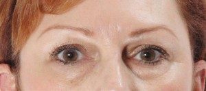 Blepharoplasty Before and After Pictures Houston, TX