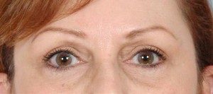 Blepharoplasty Before and After Pictures Houston, TX