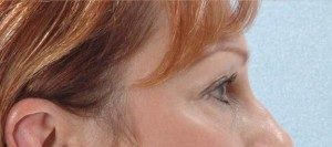 Blepharoplasty Before and After Pictures Houston, TX