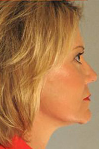 Facelift Before and After Pictures Houston, TX