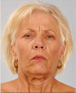 Neck Lift Before and After Pictures Houston, TX