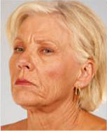 Neck Lift Before and After Pictures Houston, TX
