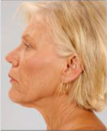 Neck Lift Before and After Pictures Houston, TX