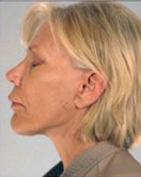 Neck Lift Before and After Pictures Houston, TX