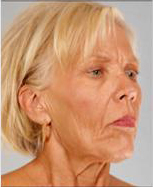 Neck Lift Before and After Pictures Houston, TX