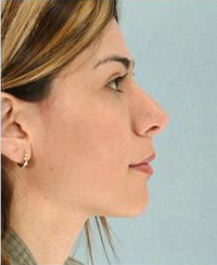 Rhinoplasty Before and After Pictures Houston, TX
