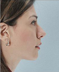 Rhinoplasty Before and After Pictures Houston, TX
