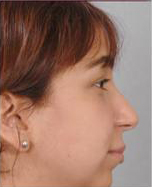 Rhinoplasty Before and After Pictures Houston, TX