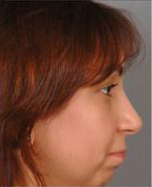 Rhinoplasty Before and After Pictures Houston, TX