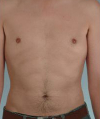 Abdominal Etching Before and After Pictures Houston, TX