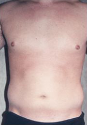 Abdominal Etching Before and After Pictures Houston, TX