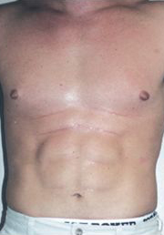 Abdominal Etching Before and After Pictures Houston, TX