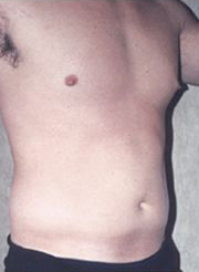 Abdominal Etching Before and After Pictures Houston, TX