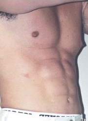 Abdominal Etching Before and After Pictures Houston, TX