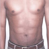 Abdominal Etching Before and After Pictures Houston, TX