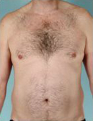 Abdominal Etching Before and After Pictures Houston, TX