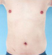 Abdominal Etching Before and After Pictures Houston, TX