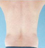 Abdominal Etching Before and After Pictures Houston, TX