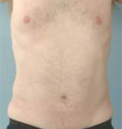 Abdominal Etching Before and After Pictures Houston, TX