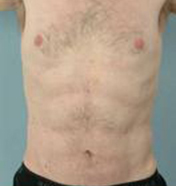 Abdominal Etching Before and After Pictures Houston, TX