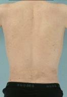 Abdominal Etching Before and After Pictures Houston, TX