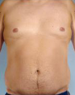 Abdominal Etching Before and After Pictures Houston, TX