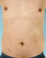 Abdominal Etching Before and After Pictures Houston, TX