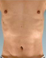 Abdominal Etching Before and After Pictures Houston, TX