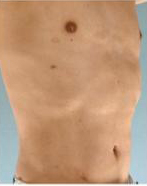 Abdominal Etching Before and After Pictures Houston, TX