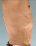 Abdominal Etching Before and After Pictures Houston, TX