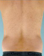 Abdominal Etching Before and After Pictures Houston, TX