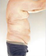 Body Lift Before and After Pictures Houston, TX