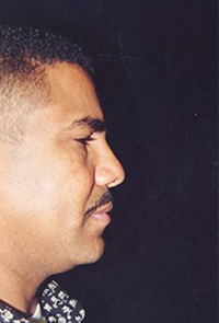 Facial Surgery Before and After Pictures Houston, TX