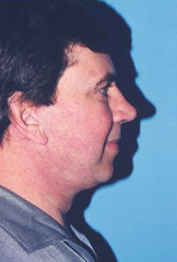 Facial Surgery Before and After Pictures Houston, TX