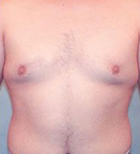 Gynecomastia Before and After Pictures Houston, TX