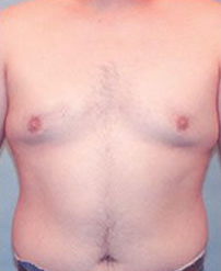 Gynecomastia Before and After Pictures Houston, TX