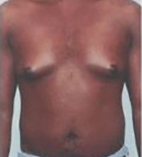 Gynecomastia Before and After Pictures Houston, TX