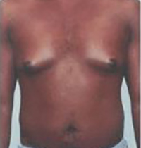 Liposuction Before and After Pictures Houston, TX