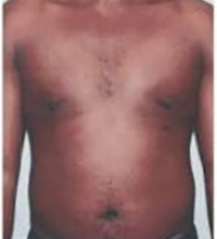 Gynecomastia Before and After Pictures Houston, TX