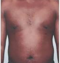 Liposuction Before and After Pictures Houston, TX