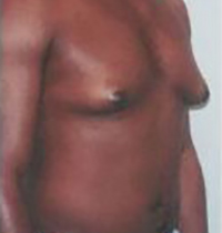 Liposuction Before and After Pictures Houston, TX