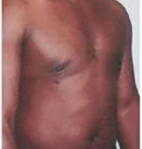 Liposuction Before and After Pictures Houston, TX