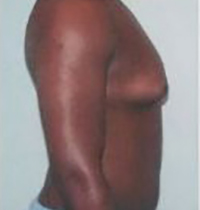 Liposuction Before and After Pictures Houston, TX