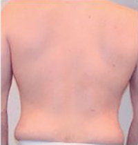 Liposuction Before and After Pictures Houston, TX