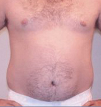 Liposuction Before and After Pictures Houston, TX