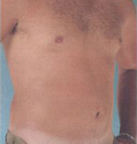 Liposuction Before and After Pictures Houston, TX