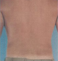 Liposuction Before and After Pictures Houston, TX