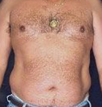 Liposuction Before and After Pictures Houston, TX