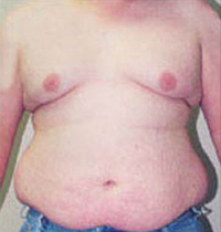 Liposuction Before and After Pictures Houston, TX