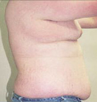 Liposuction Before and After Pictures Houston, TX